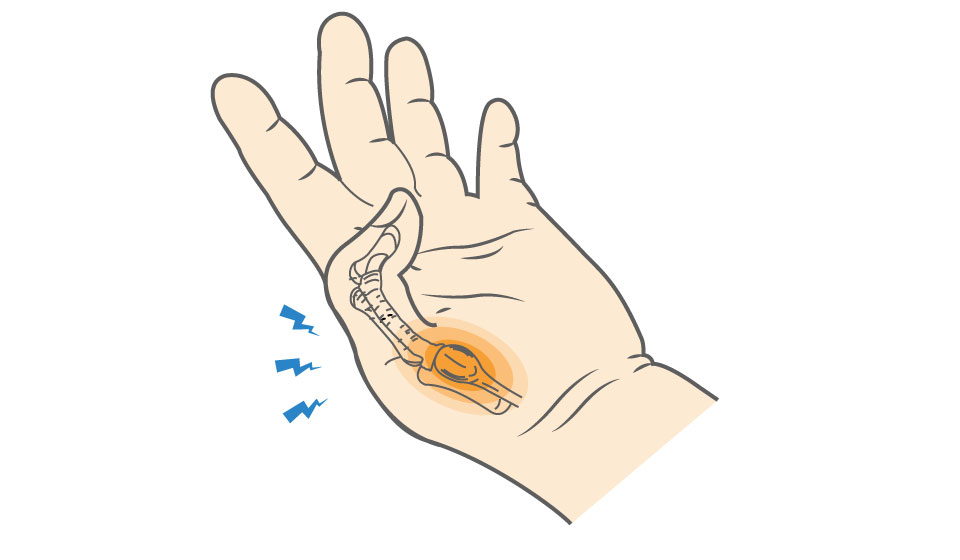 Trigger finger - Symptoms and causes - Mayo Clinic