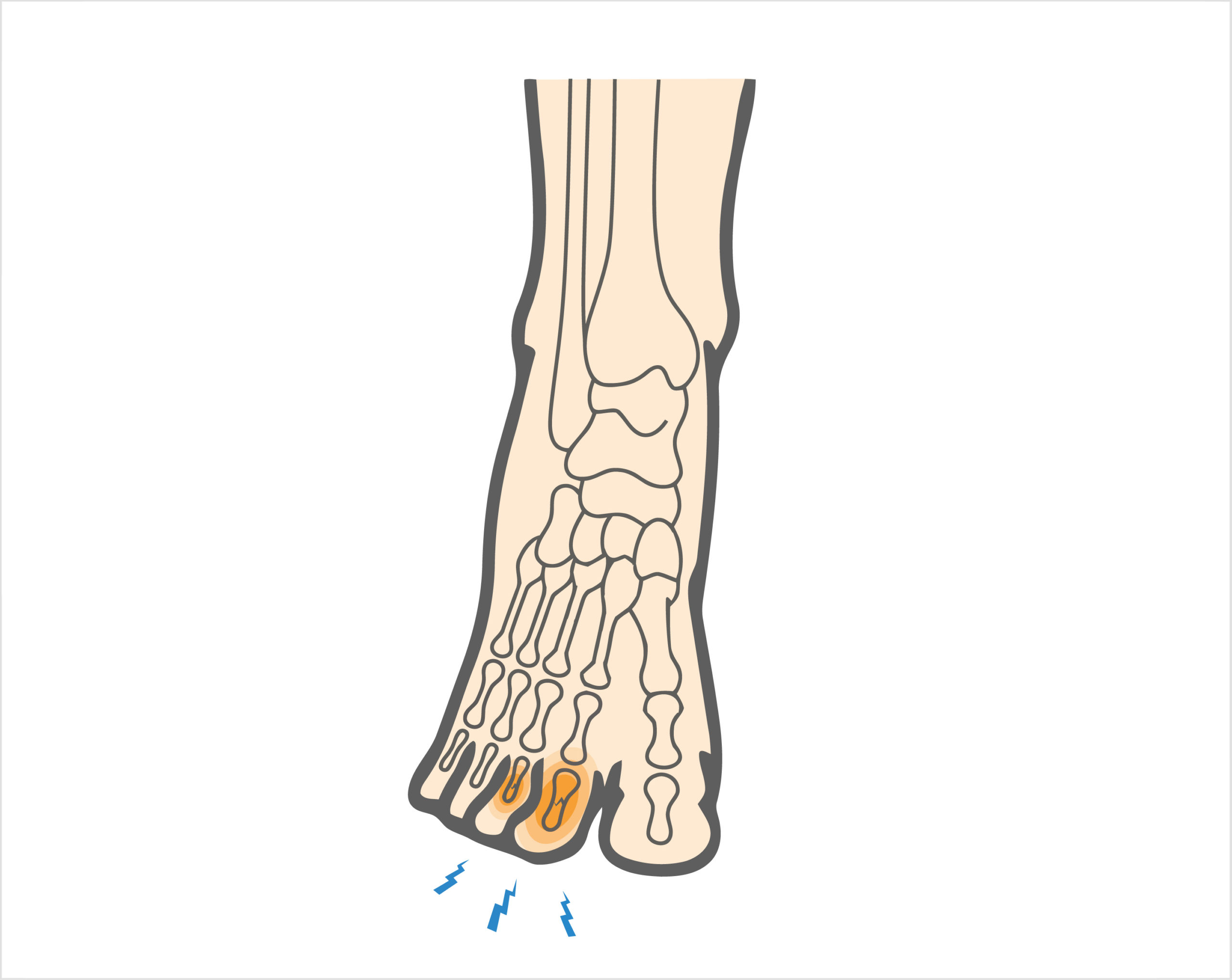 Toe Fractures Hero Image 2