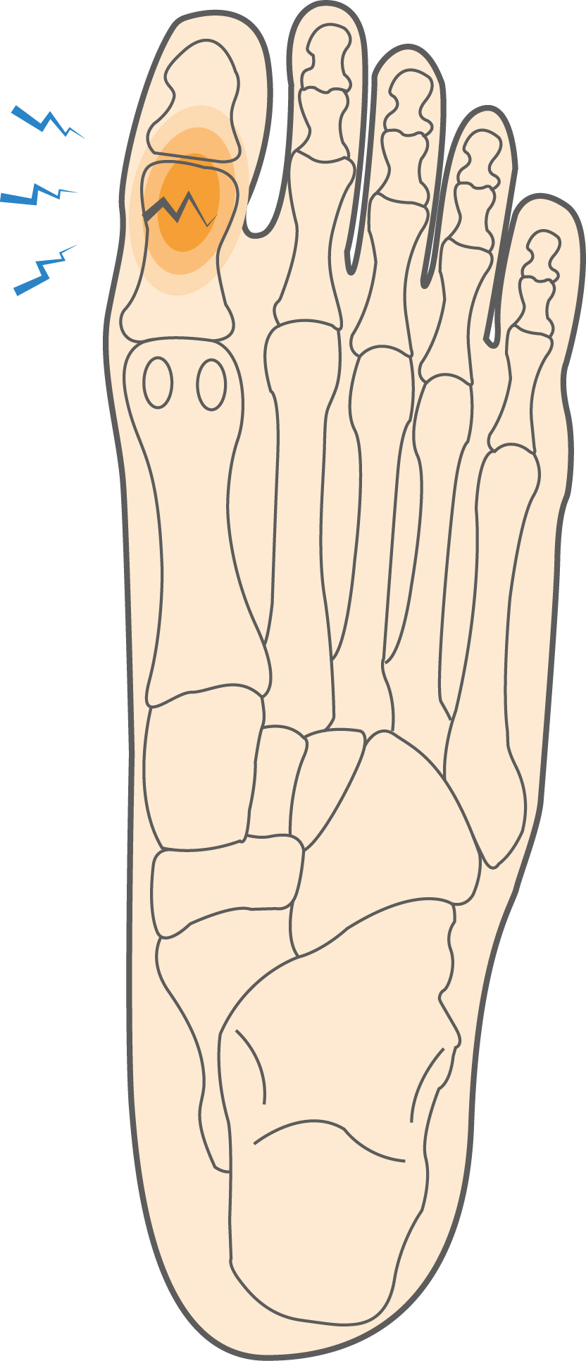 Great Toe Fracture Hero Image 2