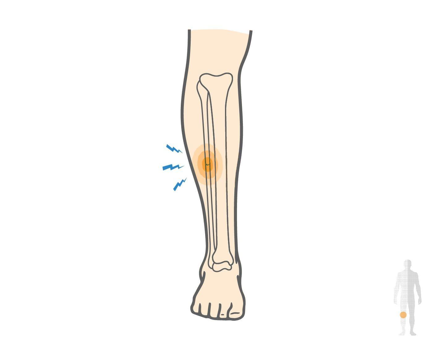 What causes a Proximal Fibula Fracture and How to Treat it? Hero Image 2